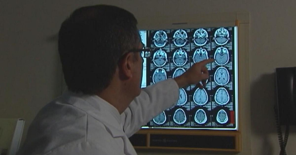 Mass General Using Artificial Intelligence to Identify Patients at Risk for Alzheimer's - Credit: CBS News
