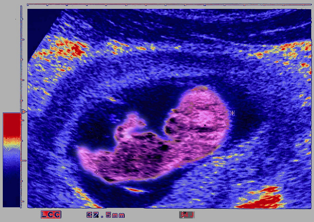 Here Is How AI Is Being Used In Fetal Ultrasounds - Credit: Forbes