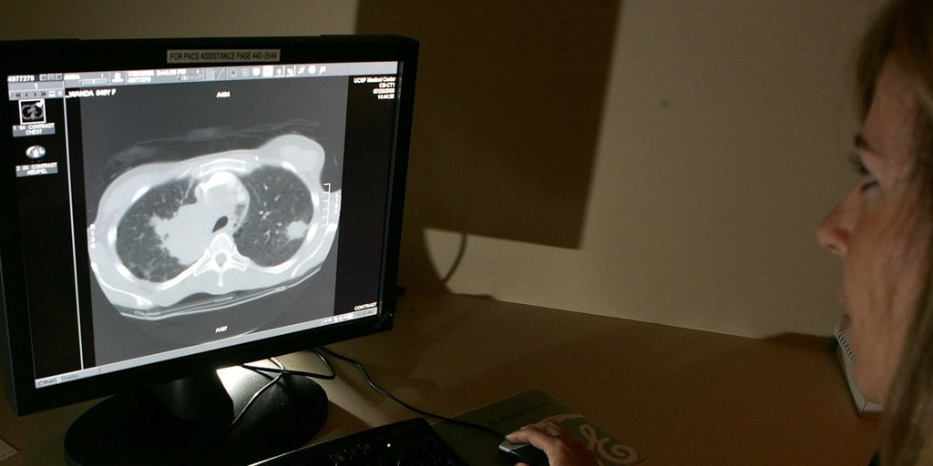 AI model Sybil can predict lung cancer risk in patients, study says - Credit: Fox News