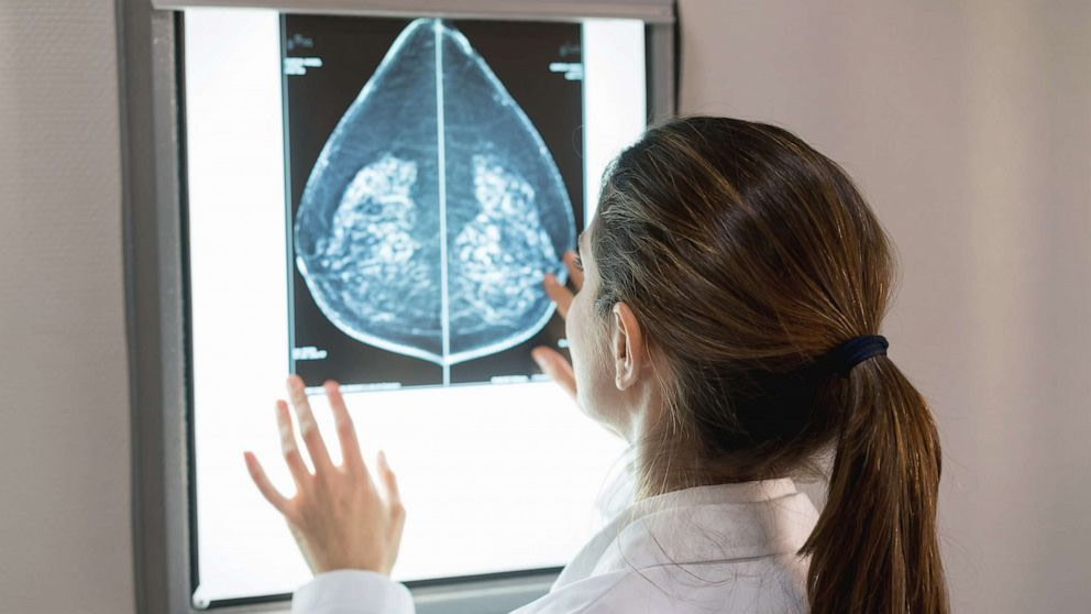 Detecting Breast Cancer with Artificial Intelligence - Credit: ABC News